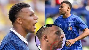 Kylian Mbappé tiene una marcas en la cara y todos se preguntan a qué se debe y esto es lo que informan desde la dermatología.