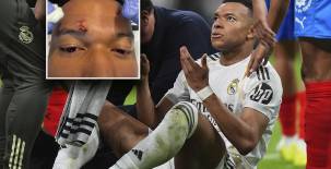 Mbappé muestra como quedó su rostro tras sufrir una agresión: Los tres puntos de la vergüenza