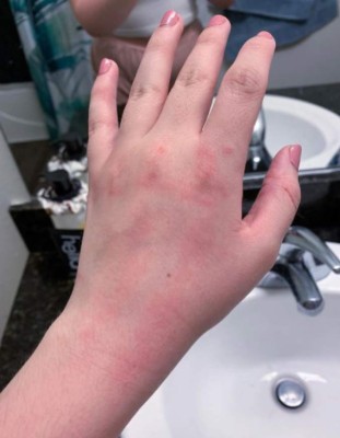 El drama de una joven influencer que es alérgica al agua: un sorbo le corta la lengua y sus lágrimas le hacen daño