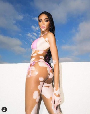 Winnie Harlow, preciosa modelo que padece de vitiligo, es 'cazada' con famoso deportista