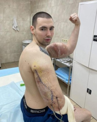 La fea lesión del Popeye ruso: le 'explotan' un brazo en plena pelea y anuncia que es el final