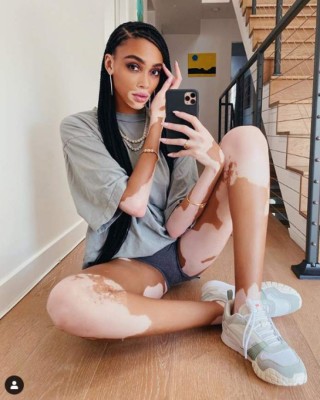 Winnie Harlow, preciosa modelo que padece de vitiligo, es 'cazada' con famoso deportista