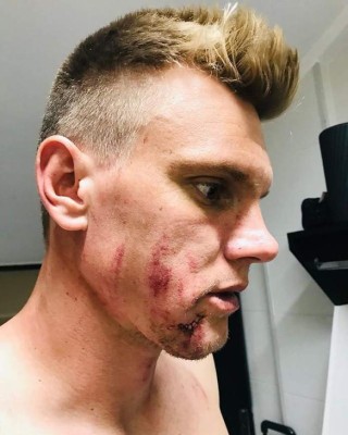 Escalofriantes: Las cicatrices más impactantes que han sufrido futbolistas y otros deportistas