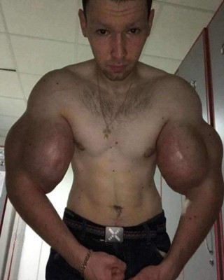 El rotundo cambio del 'Popeye' ruso: se sometió a una cirugía para salvar su vida