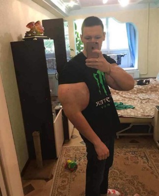 El rotundo cambio del 'Popeye' ruso: se sometió a una cirugía para salvar su vida