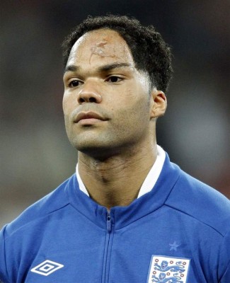 Los jugadores más famosos con cicatrices en la cara