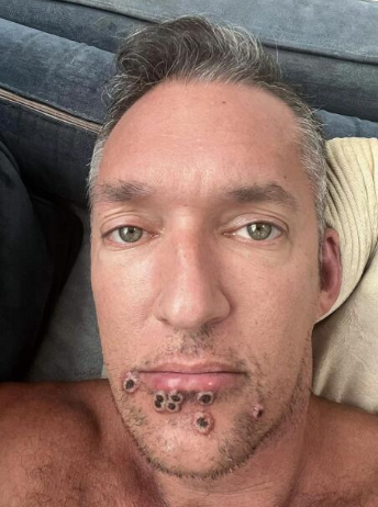 La pesadilla que vive un paciente con viruela del mono y muestra cómo tiene su cara: ‘‘Duele existir; este no soy yo’’