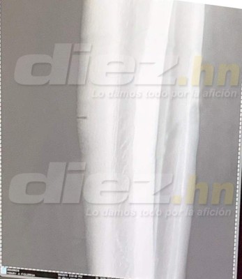 Henry Figueroa deja concentración de Honduras y estará de baja por una lesión en la tibia