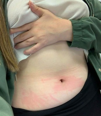 El drama de una joven influencer que es alérgica al agua: un sorbo le corta la lengua y sus lágrimas le hacen daño