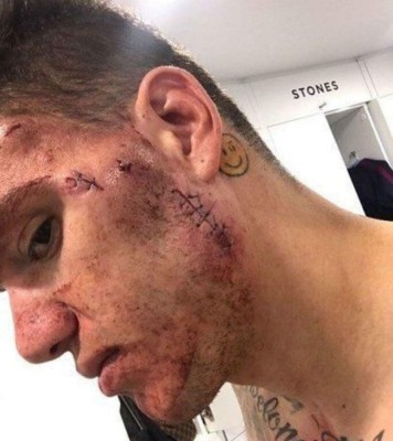 Escalofriantes: Las cicatrices más impactantes que han sufrido futbolistas y otros deportistas