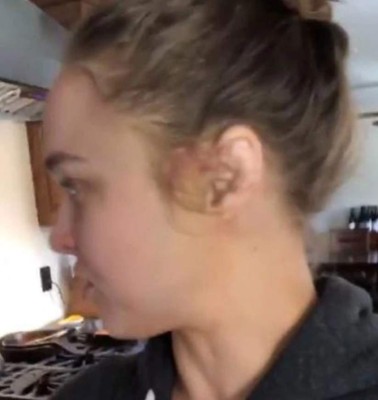 Moretones y heridas: Las fotos actualizadas de cómo quedó Ronda Rousey una semana depués de la paliza