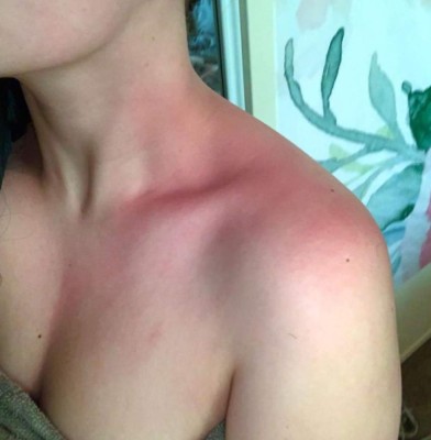 El drama de una joven influencer que es alérgica al agua: un sorbo le corta la lengua y sus lágrimas le hacen daño