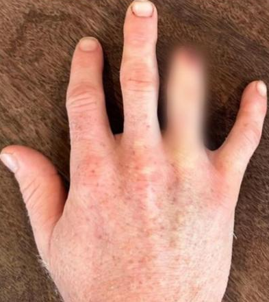 Se amputa un dedo para estar en los Juegos Olímpicos de París: “Tome la decisión, llamé a mi mujer y me dijo...”