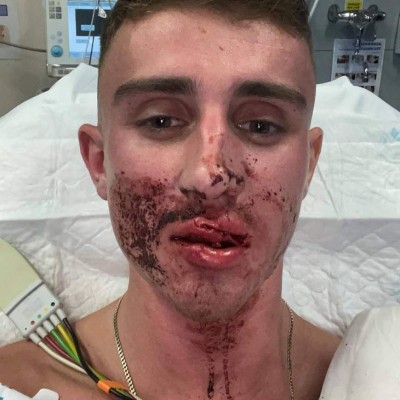 Impactantes imágenes: Ataque brutal a atleta olímpico gay que fue sometido a reconstrucción facial