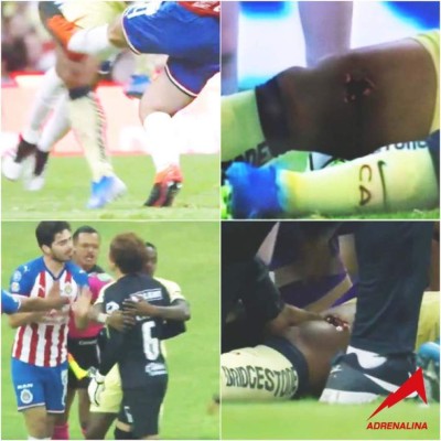 Las impactantes y terroríficas imágenes de la grave lesión de Giovanni dos Santos