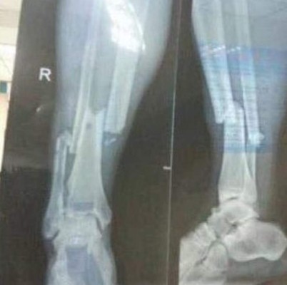 Estas son las lesiones más terribles en la historia del fútbol