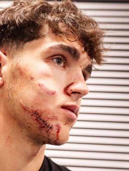 Terrible herida de Cubarsí que terminó con 10 puntos en la cara, crisis en el PSG y el penal más tonto en la historia de la Champions