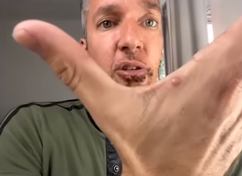 La pesadilla que vive un paciente con viruela del mono y muestra cómo tiene su cara: ‘‘Duele existir; este no soy yo’’