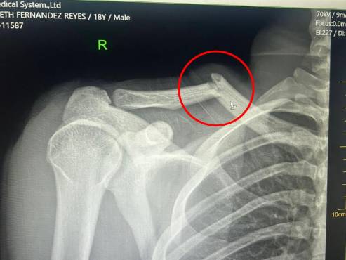 Los Rayos-X que le realizaron a Jaylor Fernández luego del choque contra Elvin Casildo en el Marathón-Victoria.