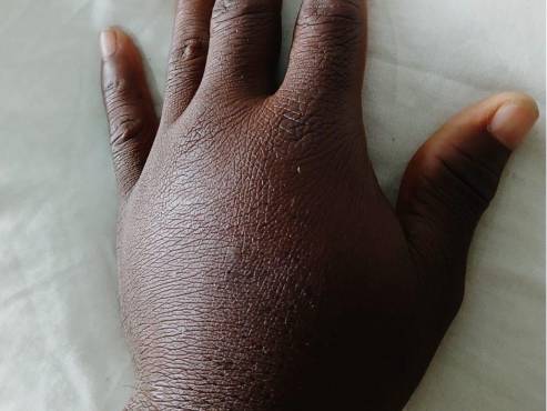 Así le quedó la mano a Suani Pérez, atacante de Juventus de Roatán.