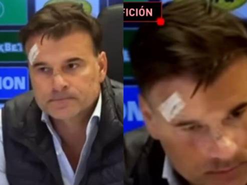Las heridas de Stanojevic en plena conferencia de prensa tras el Partizán vs Estrella Roja.