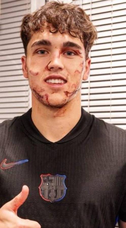 Terrible herida de Cubarsí que terminó con 10 puntos en la cara, crisis en el PSG y el penal más tonto en la historia de la Champions