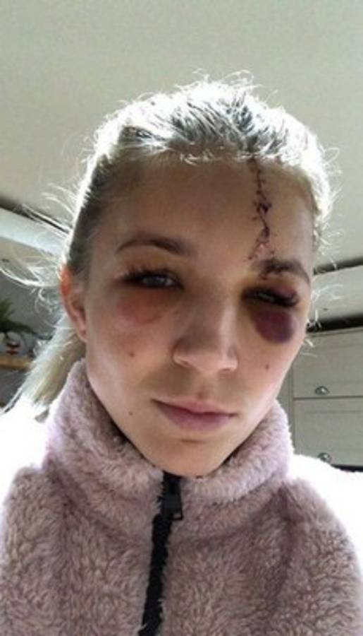 La bella portera del Liverpool sufre un escalofriante corte en la cabeza y muestra su cicatriz