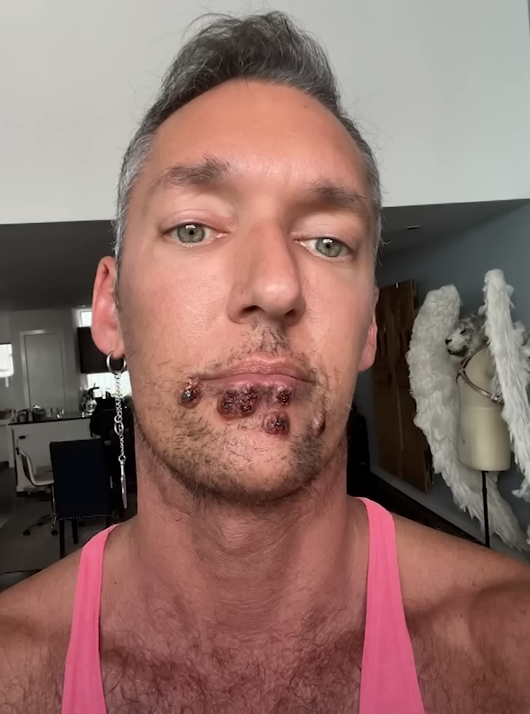 La pesadilla que vive un paciente con viruela del mono y muestra cómo tiene su cara: ‘‘Duele existir; este no soy yo’’