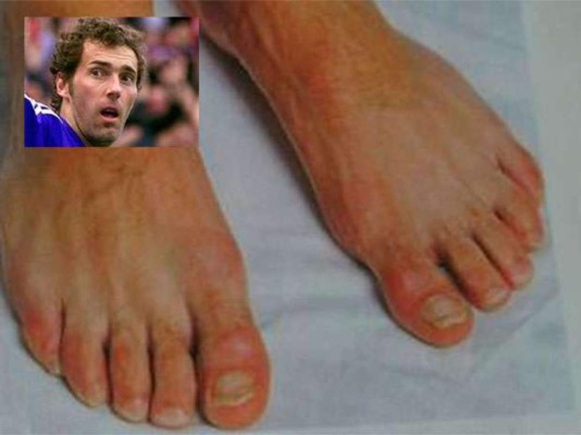 ¡HORRIBLES! Así son los pies más feos de los deportistas famosos