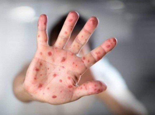 Las pandemias más mortíferas que han azotado a la humanidad a lo largo de la historia