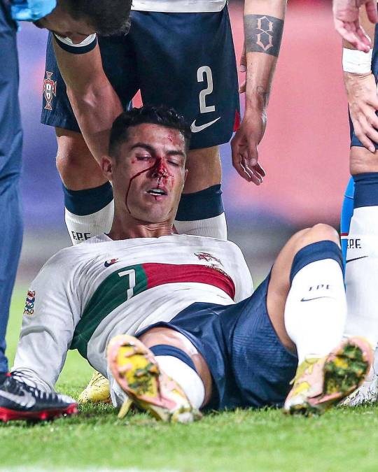 Los checos le dieron con todo: Cristiano Ronaldo sufre durísimo golpe que lo dejó tendido en el suelo y sangrando