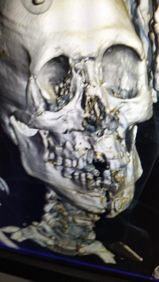 ¡Impactante momento! Confirman alcance de la lesión de Al Shahrani, jugador de Arabia Saudí tras vencer a Argentina