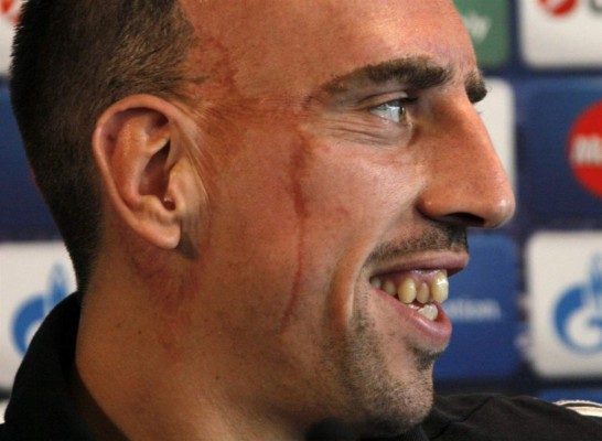 Los jugadores más famosos con cicatrices en la cara