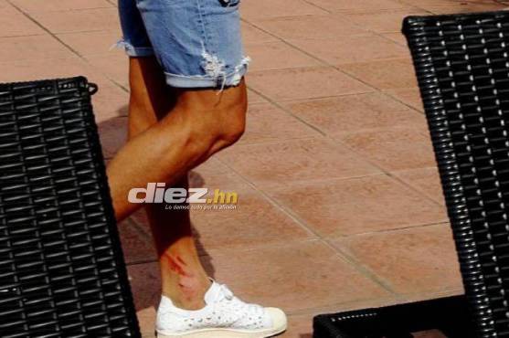 Así quedó el tobillo izquierdo luego del segundo choque de las semifinales ante Olimpia.