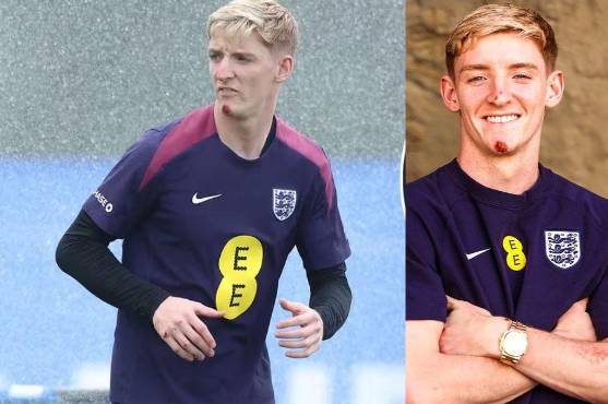 Jugador de Inglaterra sufre accidente previo a jugar los octavos de final en la Eurocopa: “Tenía la cara ensangrentada”