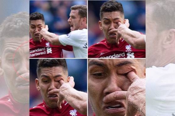 La impactante fotografía de la lesión de ojo de Roberto Firmino.