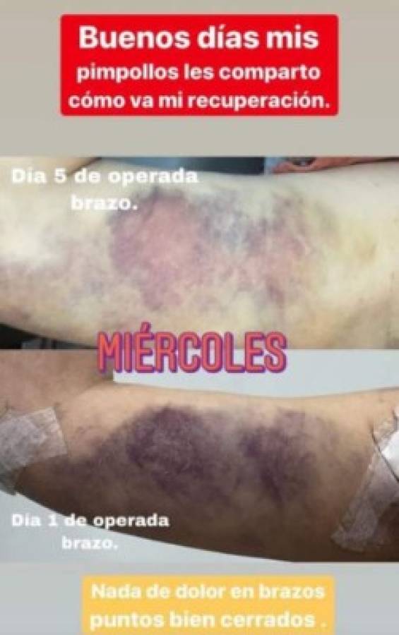 El antes y el después de la guapa Alejandra Rubio tras las cirugías plásticas