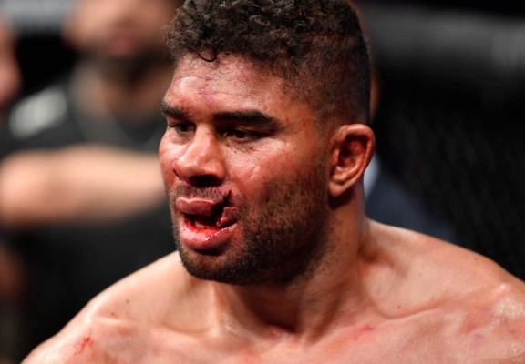 ¡Terribles fotos! De un brutal golpe le rompen los labios a un peleador en la UFC