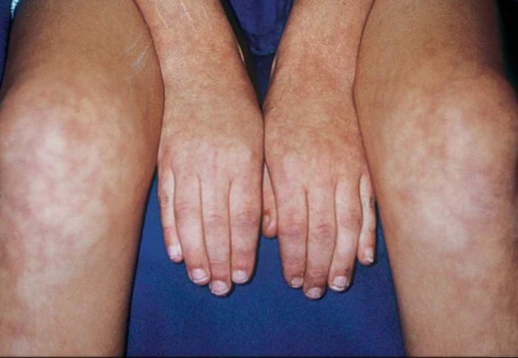 Nuevos síntomas del coronavirus: Las cinco manifestaciones que se producen en la piel&nbsp;&nbsp;