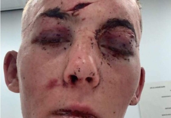 Cara desfigurada y huesos rotos: La paliza que le dieron a un soldado tras ser secuestrado en una cita de Tinder