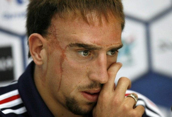 Los jugadores más famosos con cicatrices en la cara