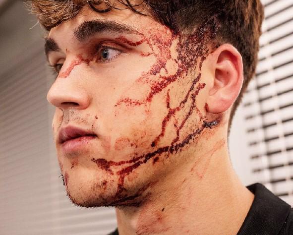 Terrible herida de Cubarsí que terminó con 10 puntos en la cara, crisis en el PSG y el penal más tonto en la historia de la Champions