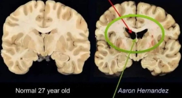 Las impactantes revelaciones sobre Aaron Hernández en el documental de Netflix