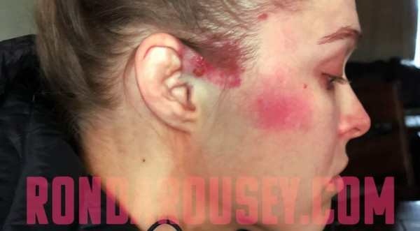 Ronda Rousey muestra sus impactantes lesiones tras la paliza en la WWE