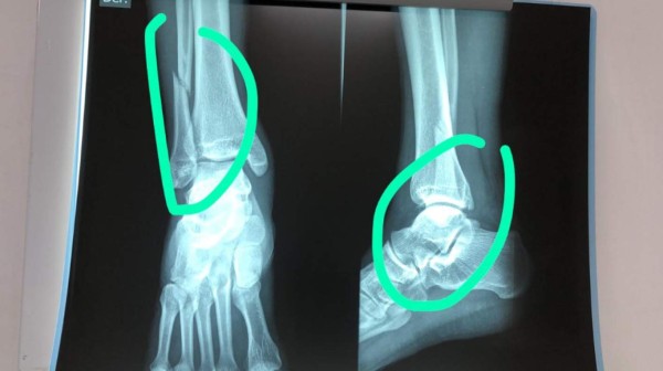 NO SE VIO: Invasión de olimpistas, celebración a lo CR7 y jugador con doble quebradura