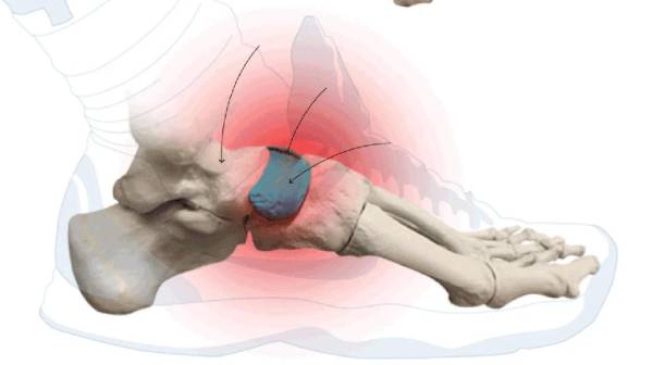 El hueso escafoide del que fue operado el defensor hondureño Denil Maldonado.