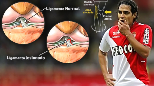 Informe médico: Lesión de Falcao sí es grave