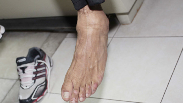 Así le dejaron el tobillo a Amado Guevara