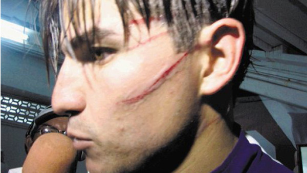 Así le quedó la cara a un jugador tico tras ser aruñado
