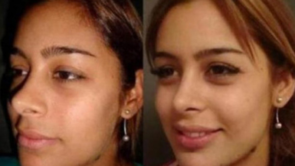 Larissa: antes y después del bisturí